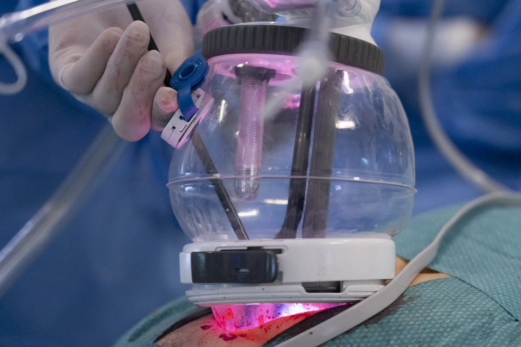 Close-up of the single-port device placed on the patient's abdomen, through which all of the robot's instruments enter