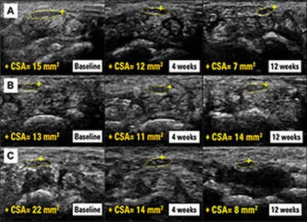 Ultrasound scans of the median nerve in three patients at baseline, four weeks and twelve weeks, with its area outlined in yellow