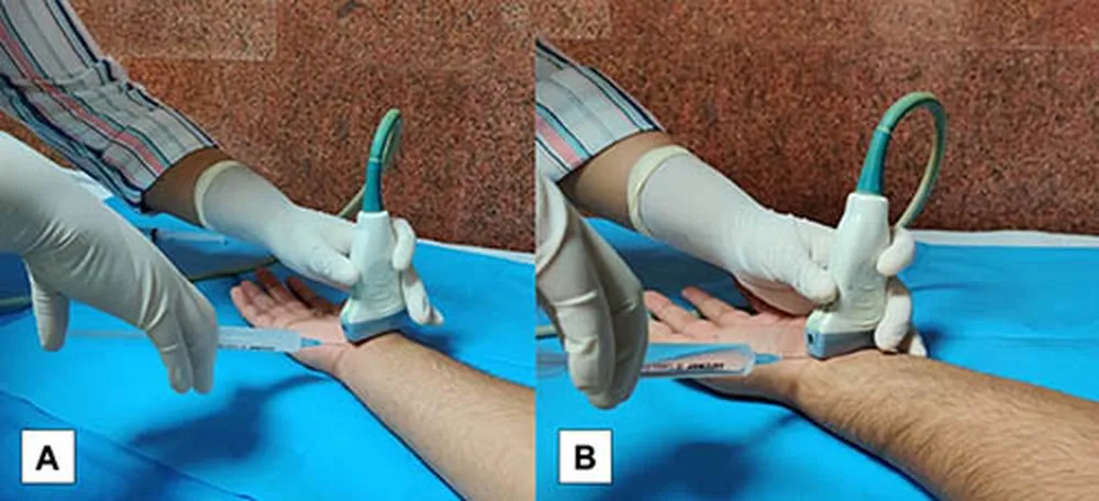 Two photographs of a wrist on a blue drape: a gloved hand holds an ultrasound probe while another inserts a thin needle beside it